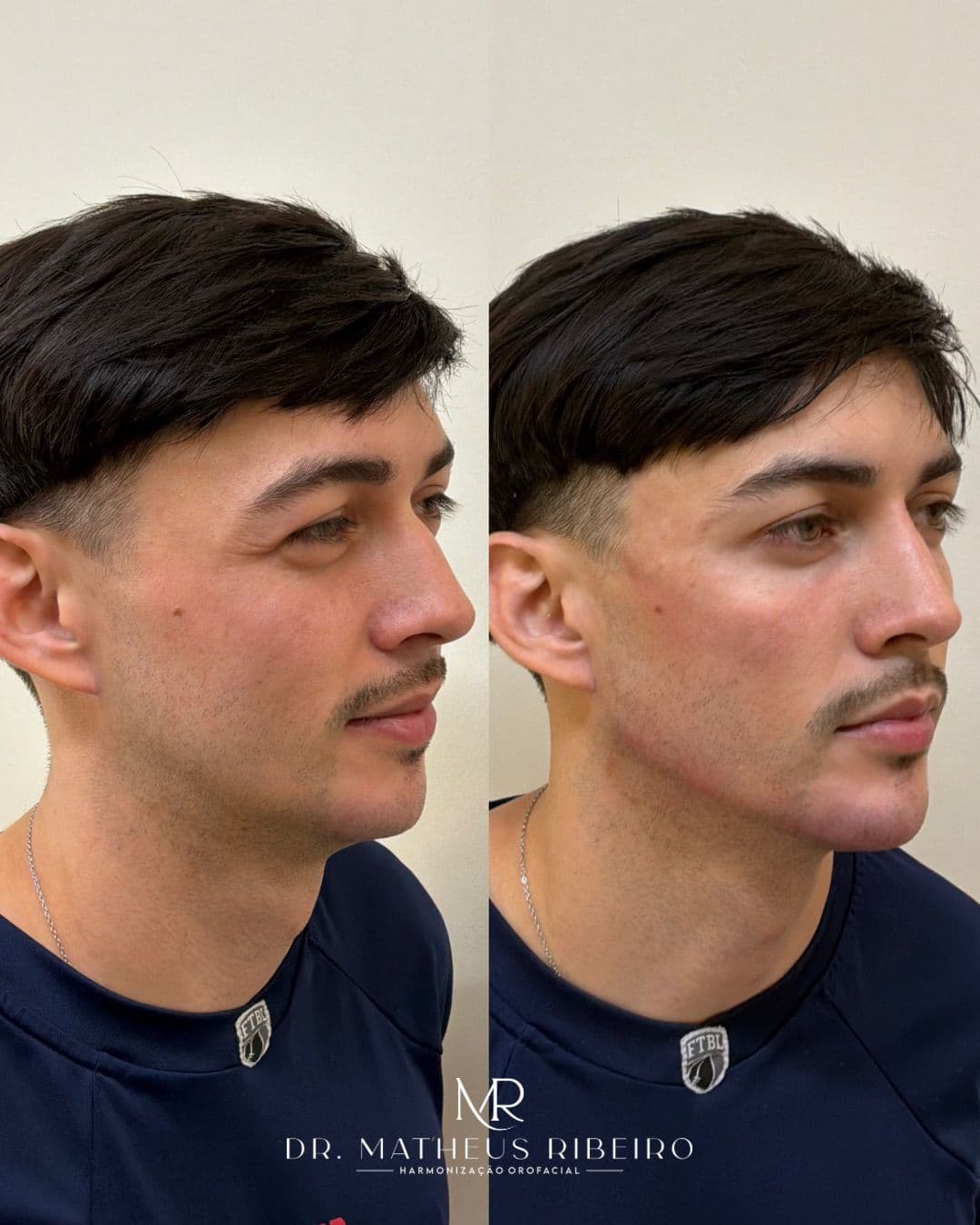 Antes e depois de harmonização facial masculina — homem jovem, perfil em três quartos