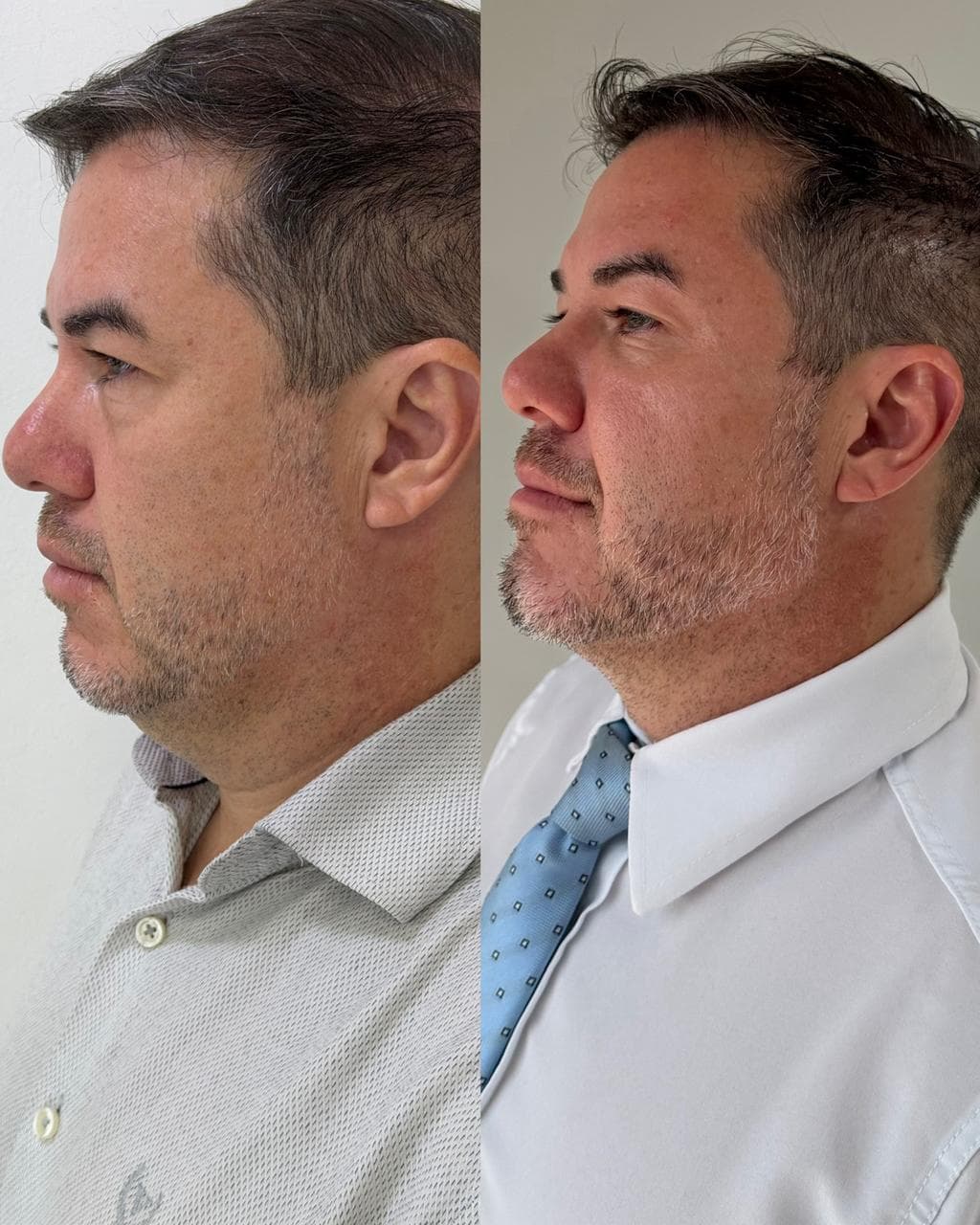 Antes e depois de harmonização facial masculina — homem na faixa dos 45 anos, perfil