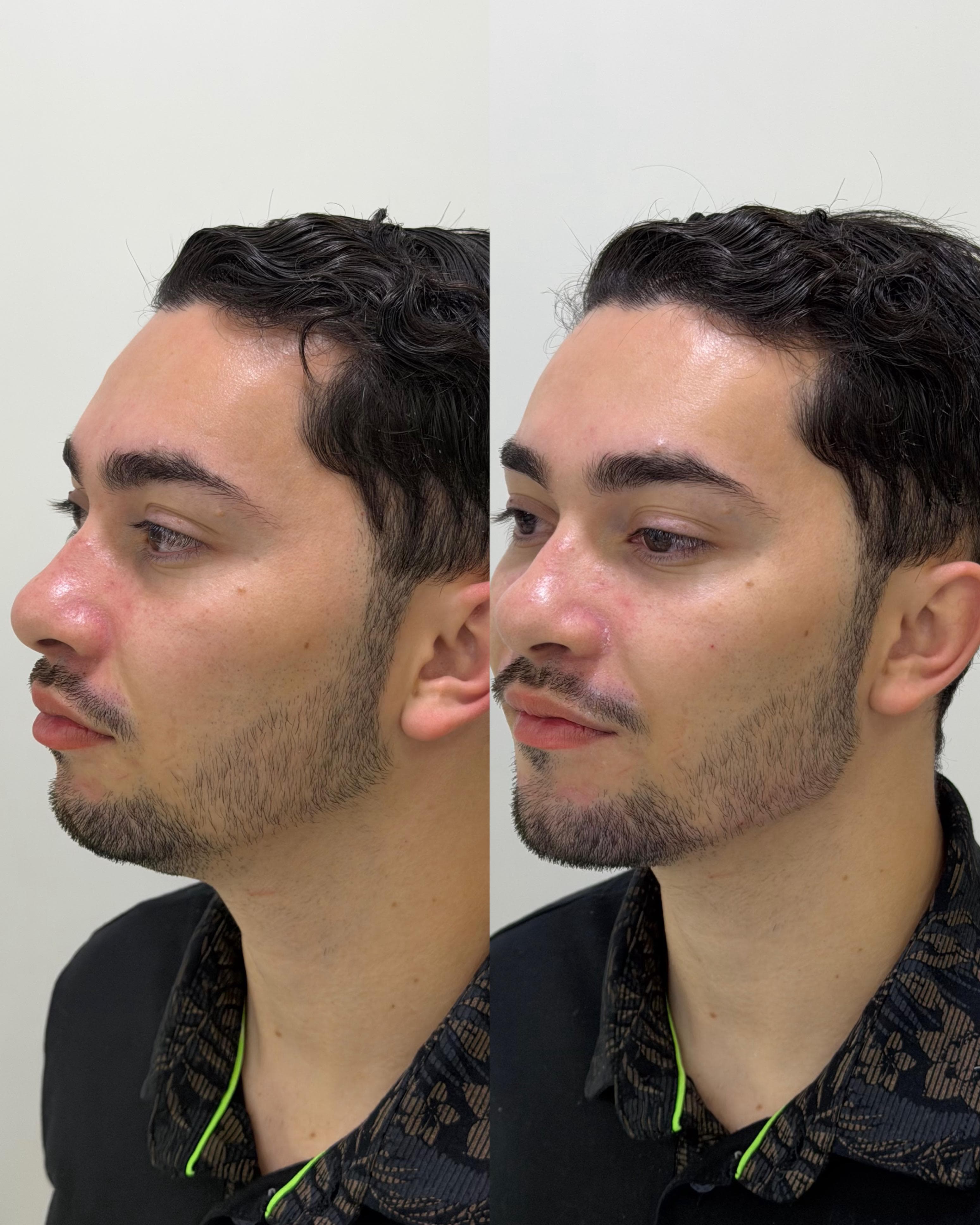 Antes e depois de harmonização facial masculina — homem jovem, perfil