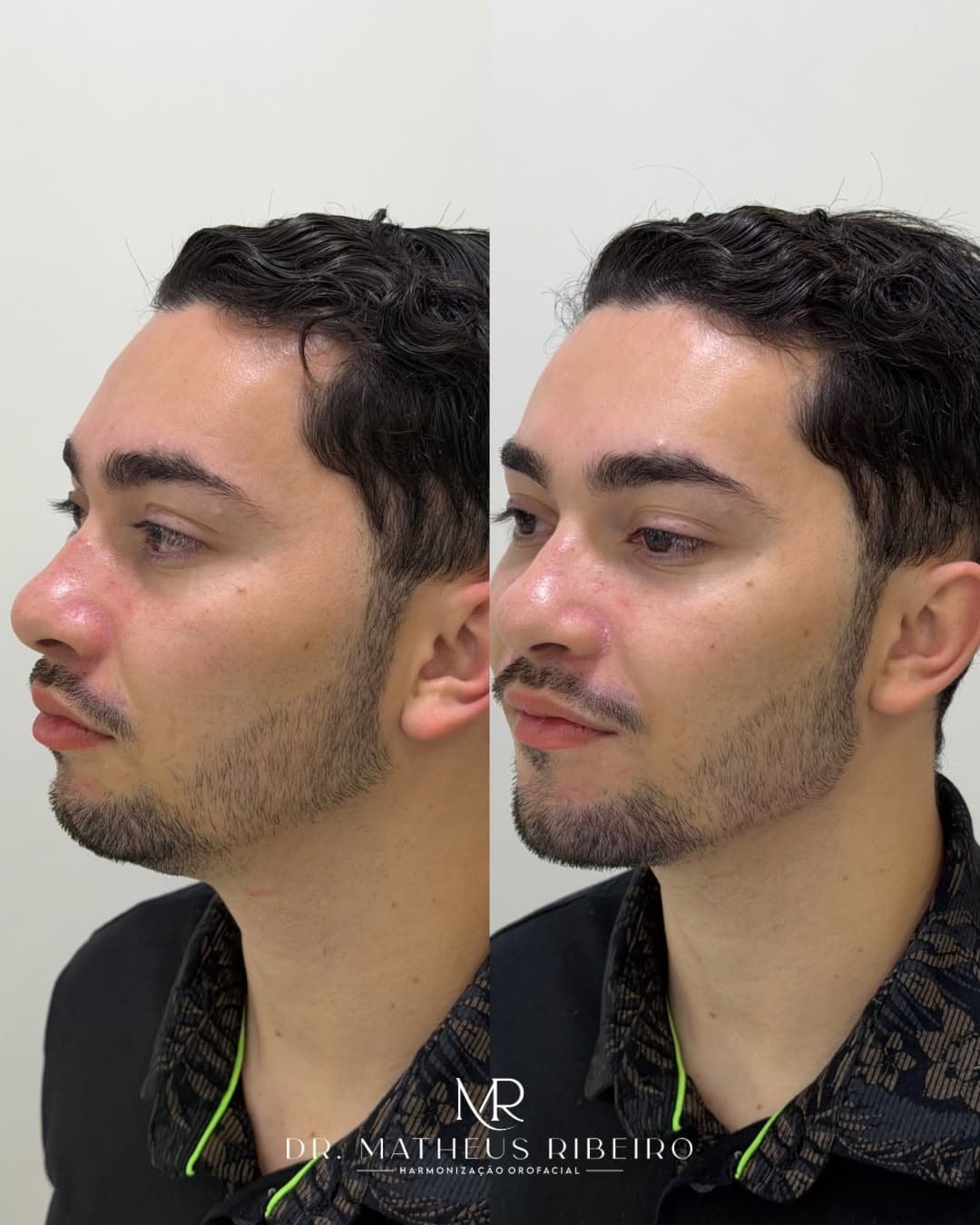 Antes e depois de harmonização facial masculina — homem jovem, perfil