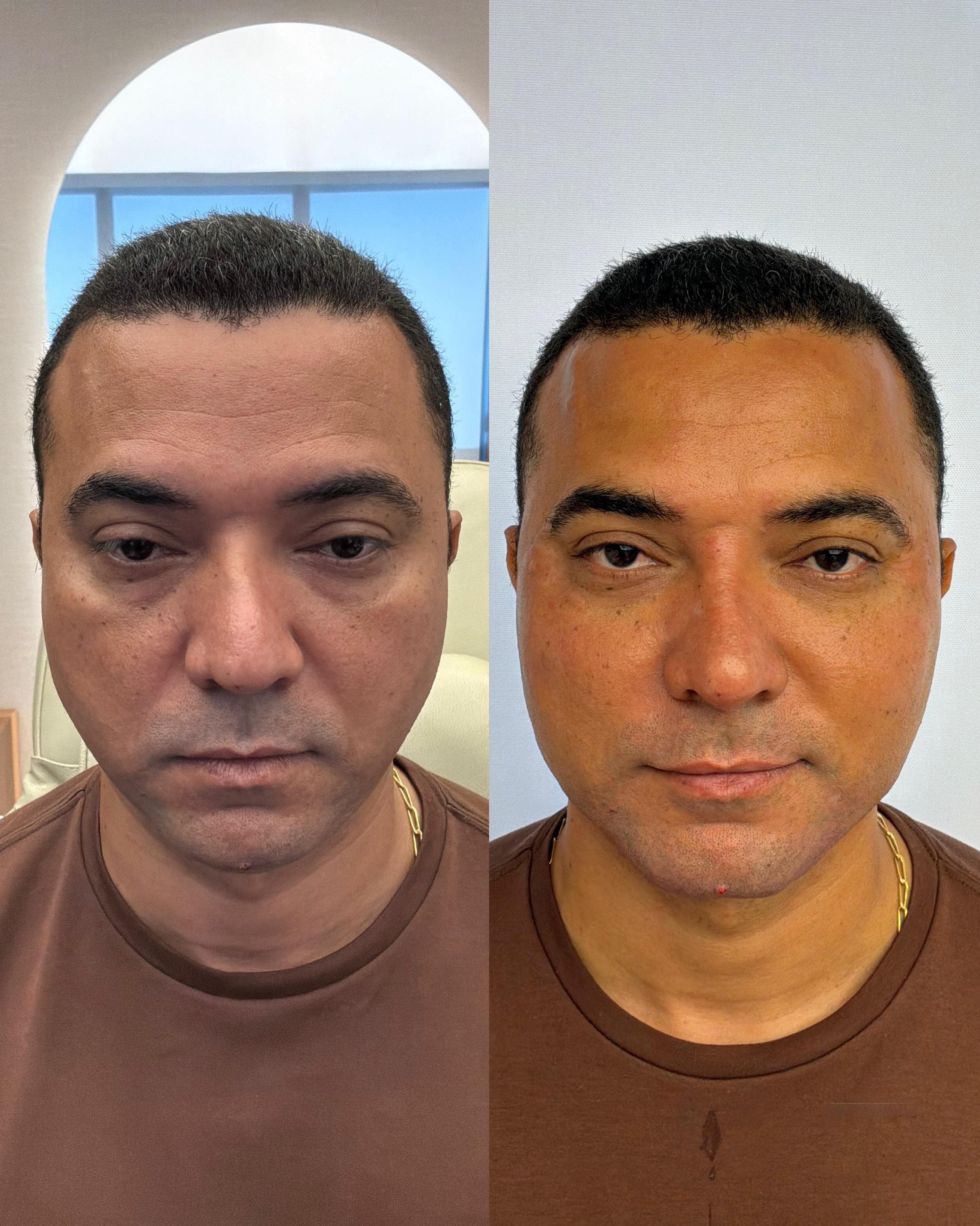 Antes e depois de harmonização facial masculina — homem na faixa dos 40 anos, vista frontal
