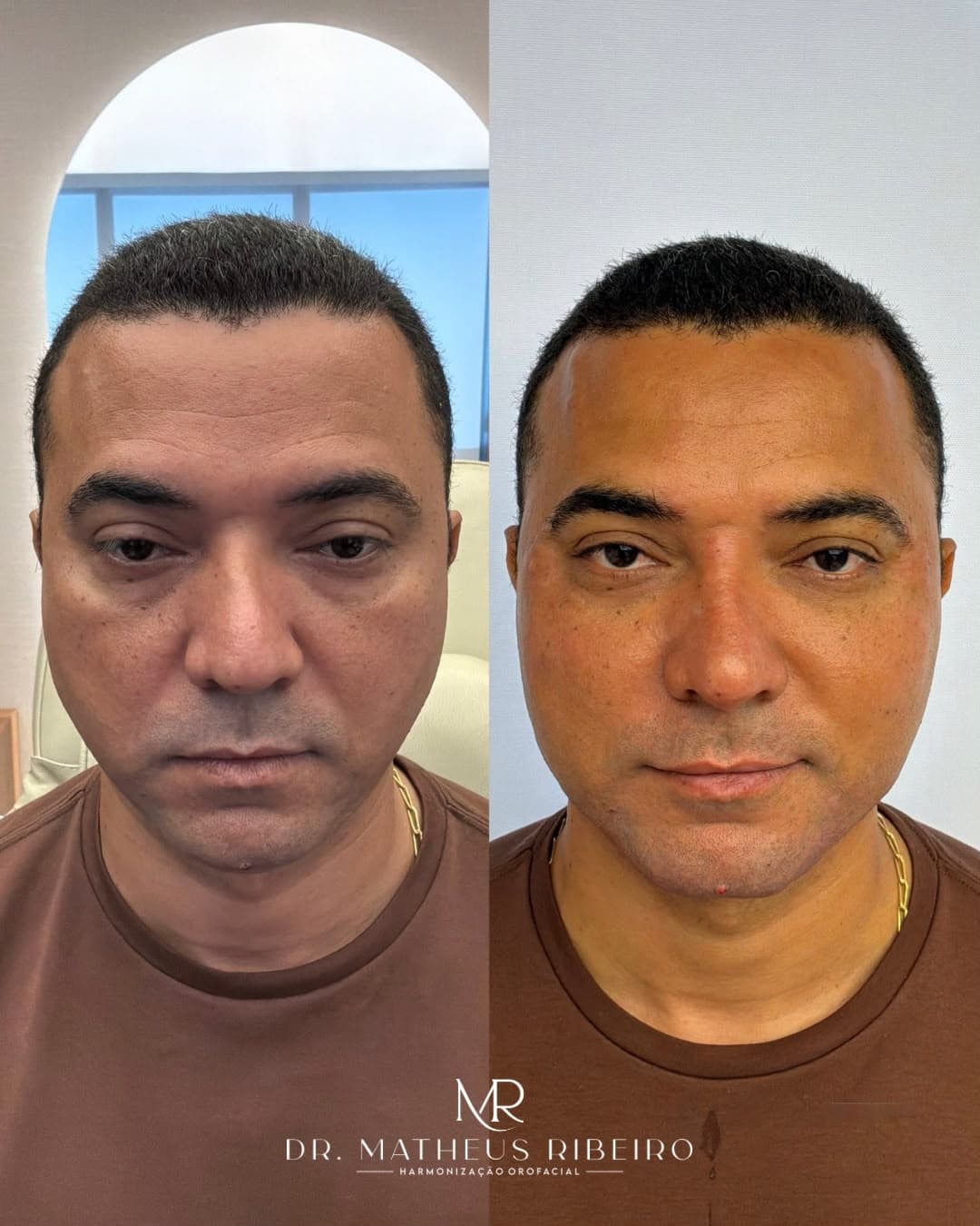 Antes e depois de harmonização facial masculina — homem na faixa dos 40 anos, vista frontal