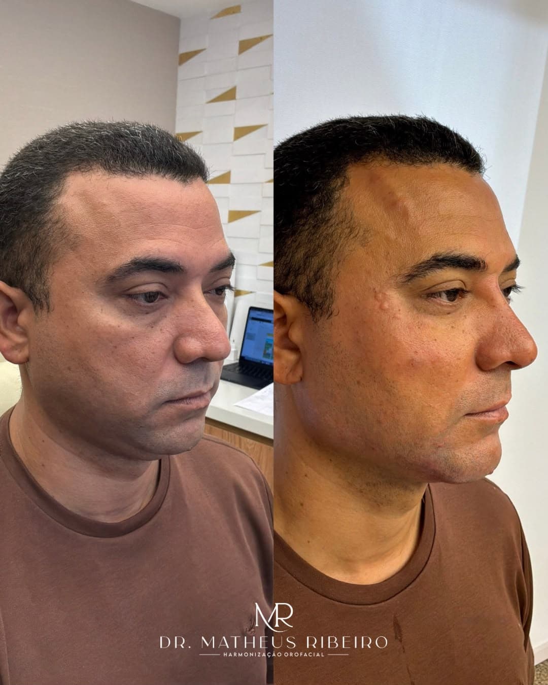 Antes e depois de harmonização facial masculina — homem na faixa dos 40 anos, perfil em três quartos