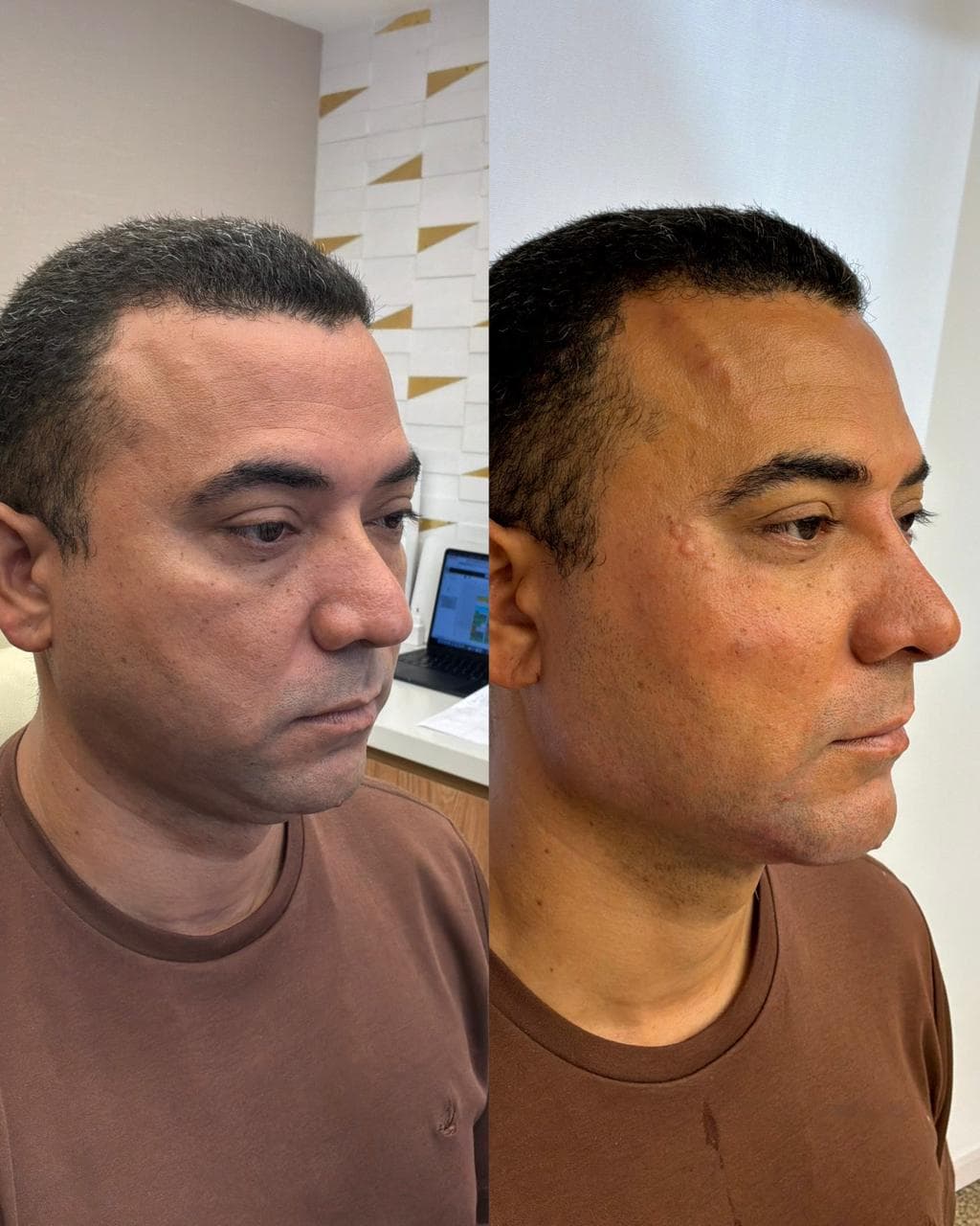 Antes e depois de harmonização facial masculina — homem na faixa dos 40 anos, perfil em três quartos