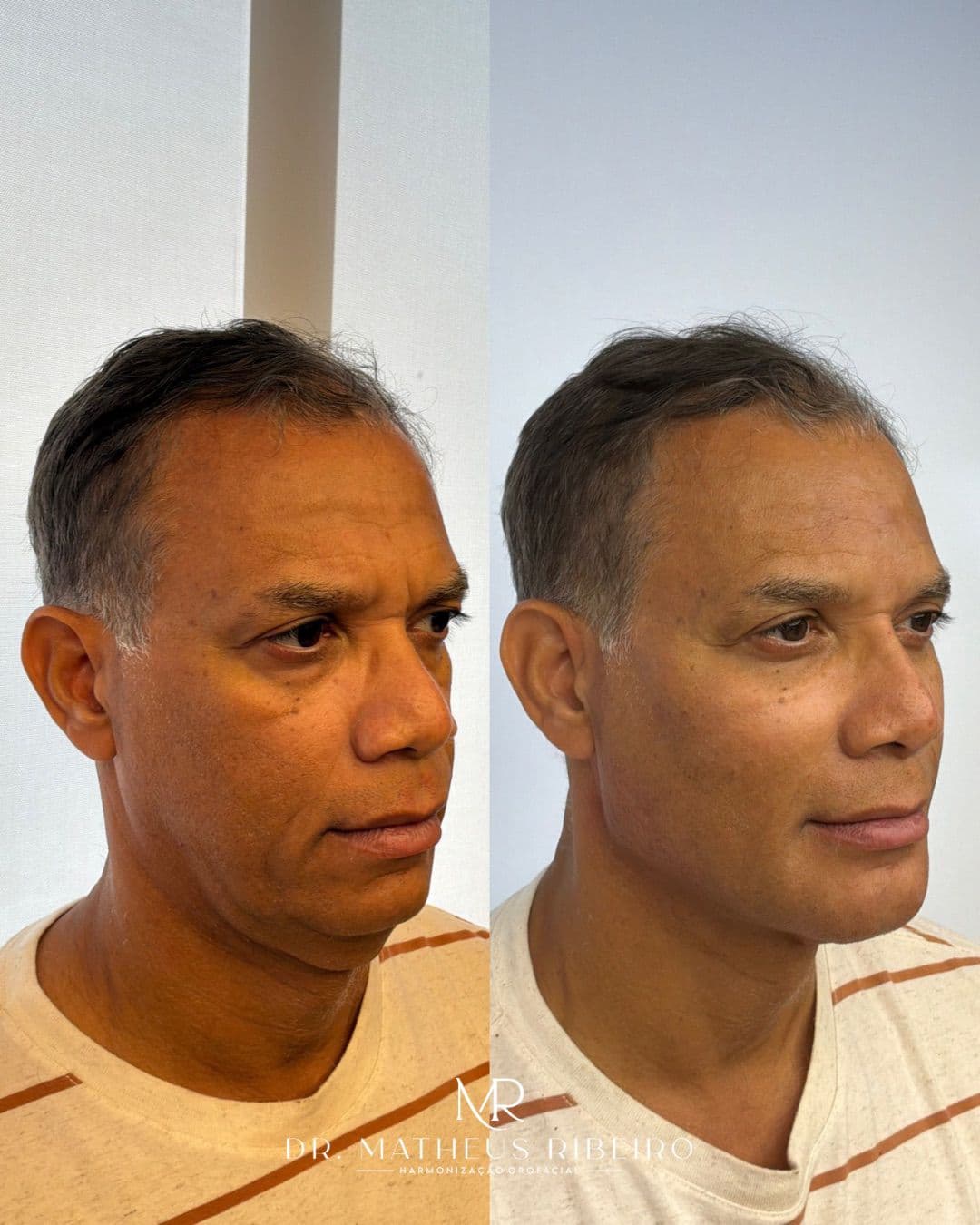 Antes e depois de harmonização facial masculina — homem na faixa dos 55 anos
