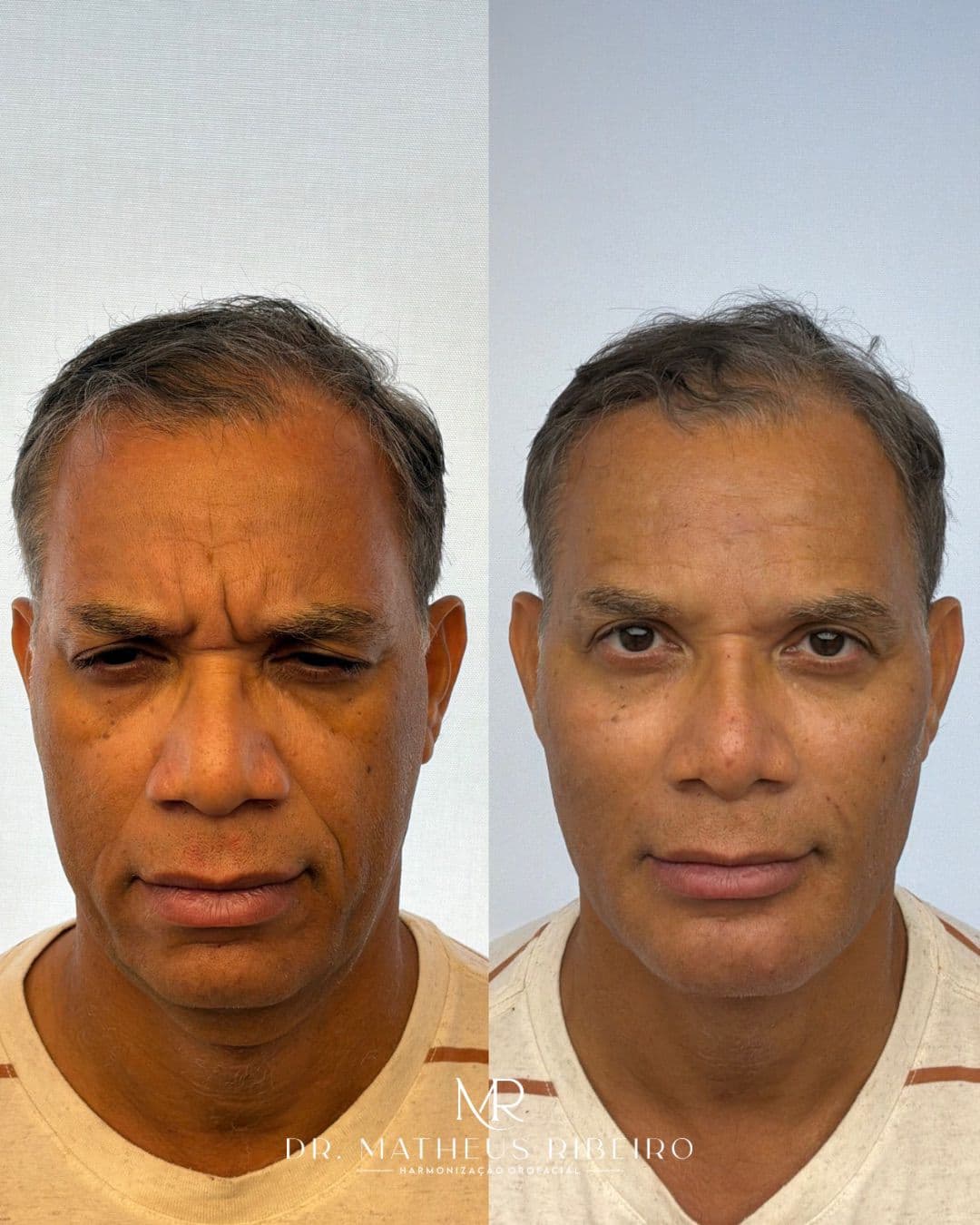 Antes e depois de harmonização facial masculina — homem na faixa dos 55 anos, vista frontal