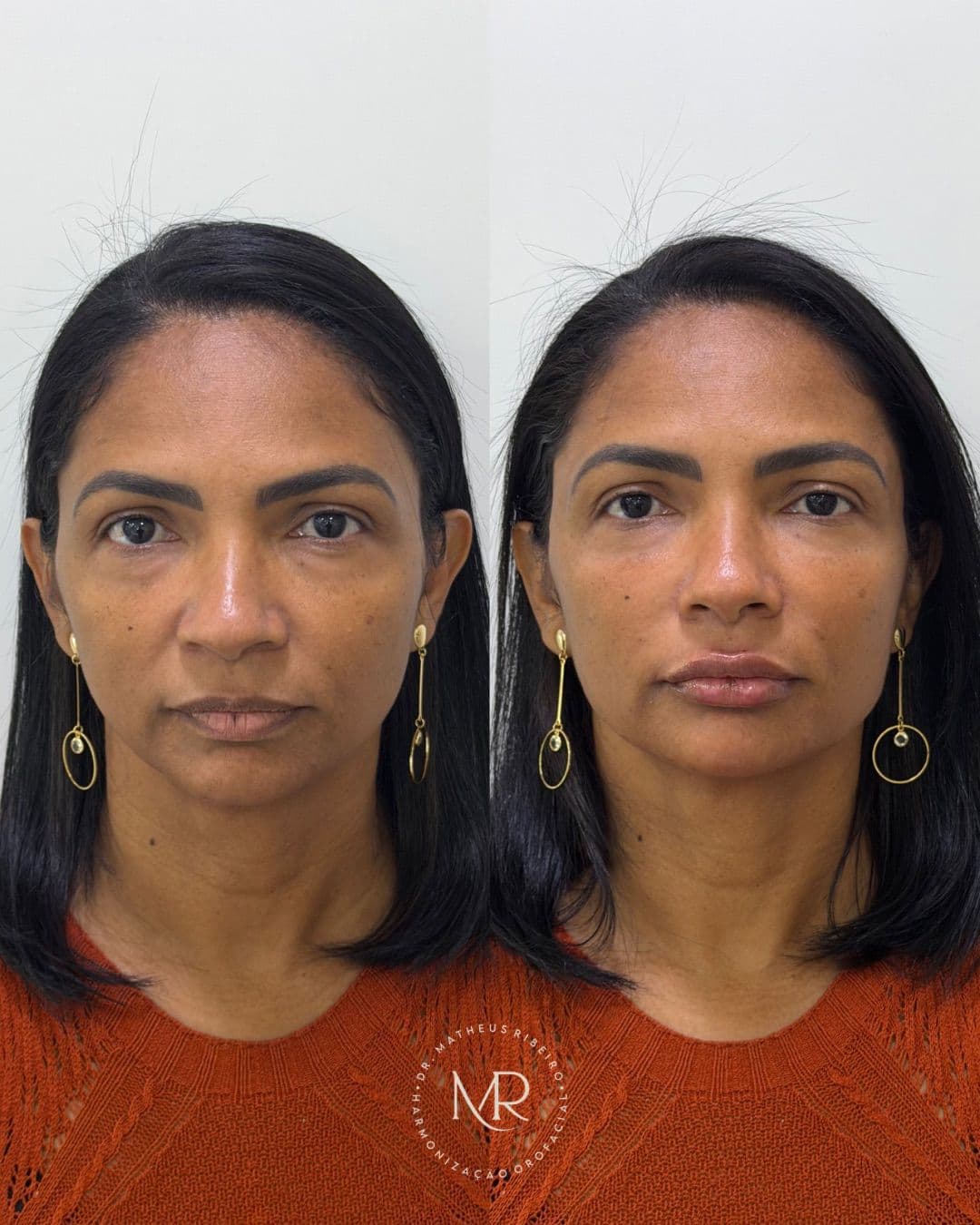 Antes e depois de harmonização facial — mulher na faixa dos 40 anos, vista frontal