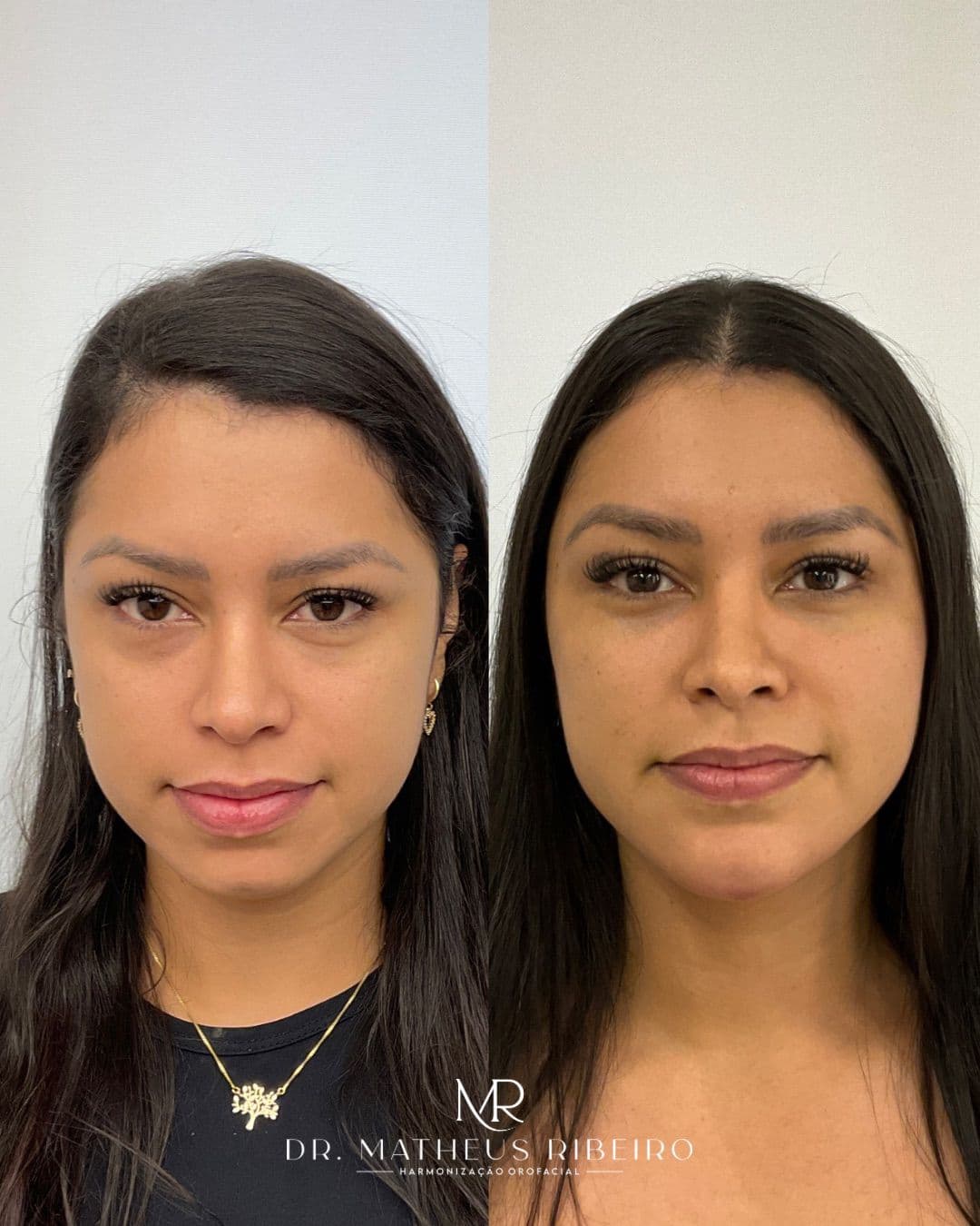Antes e depois de harmonização facial — mulher na faixa dos 25 anos, vista frontal