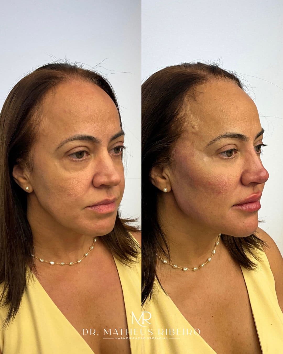 Antes e depois de harmonização facial — mulher na faixa dos 50 anos