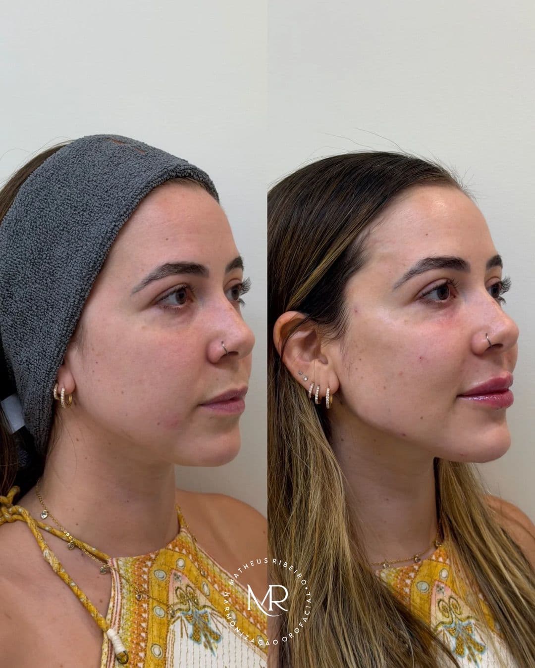 Antes e depois de harmonização facial — mulher na faixa dos 25 anos