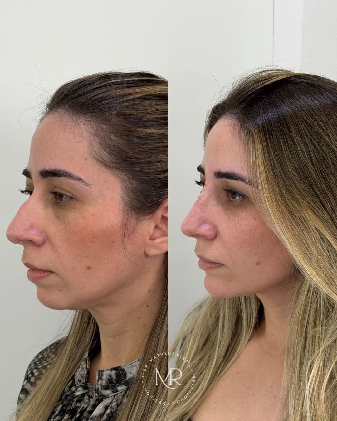 Antes e depois de harmonização facial — mulher na faixa dos 35 anos, perfil