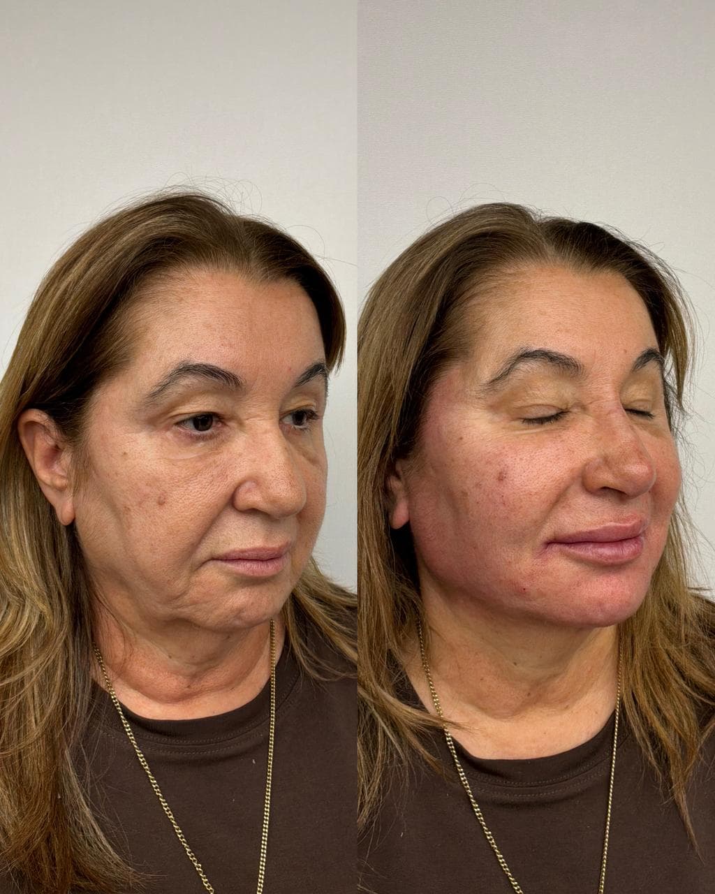 Antes e depois de harmonização facial — mulher na faixa dos 60 anos, perfil em três quartos