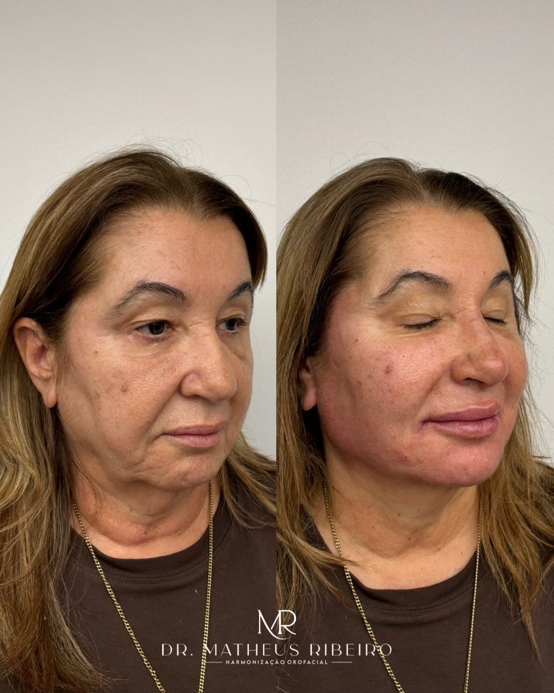 Antes e depois de harmonização facial — mulher na faixa dos 60 anos, perfil em três quartos