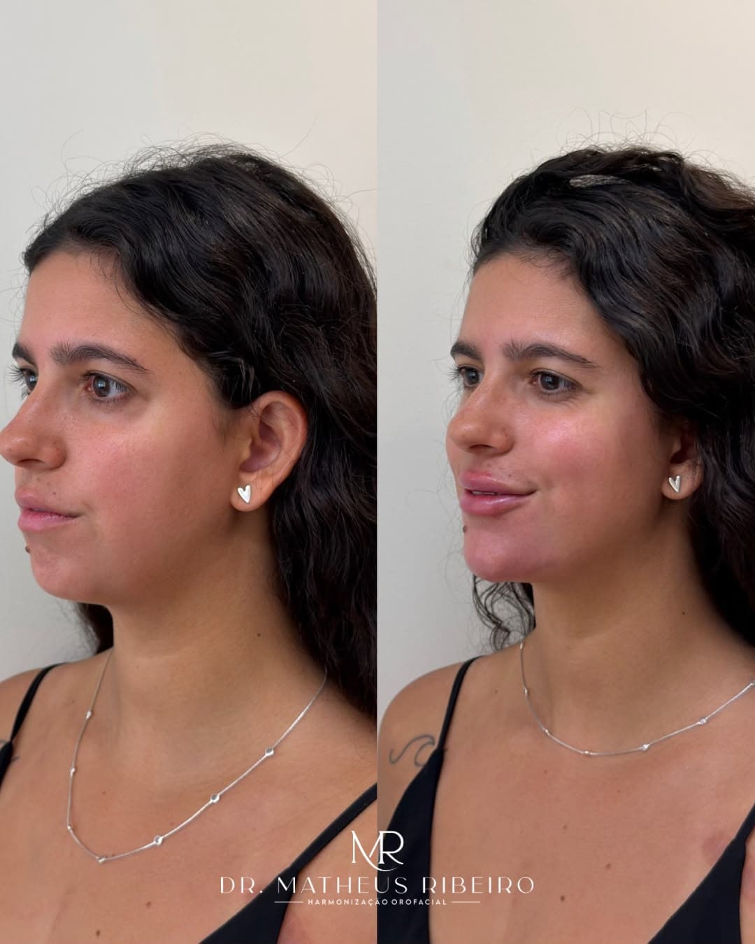 Antes e depois de harmonização facial — mulher na faixa dos 25 anos, perfil em três quartos