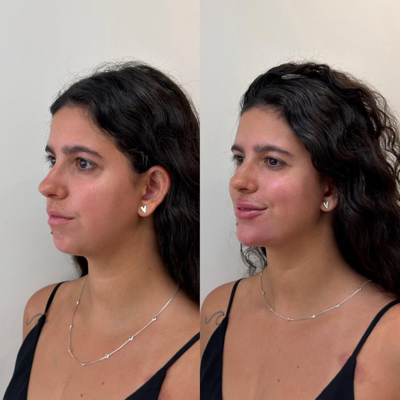 Antes e depois de harmonização facial — mulher na faixa dos 25 anos, perfil em três quartos
