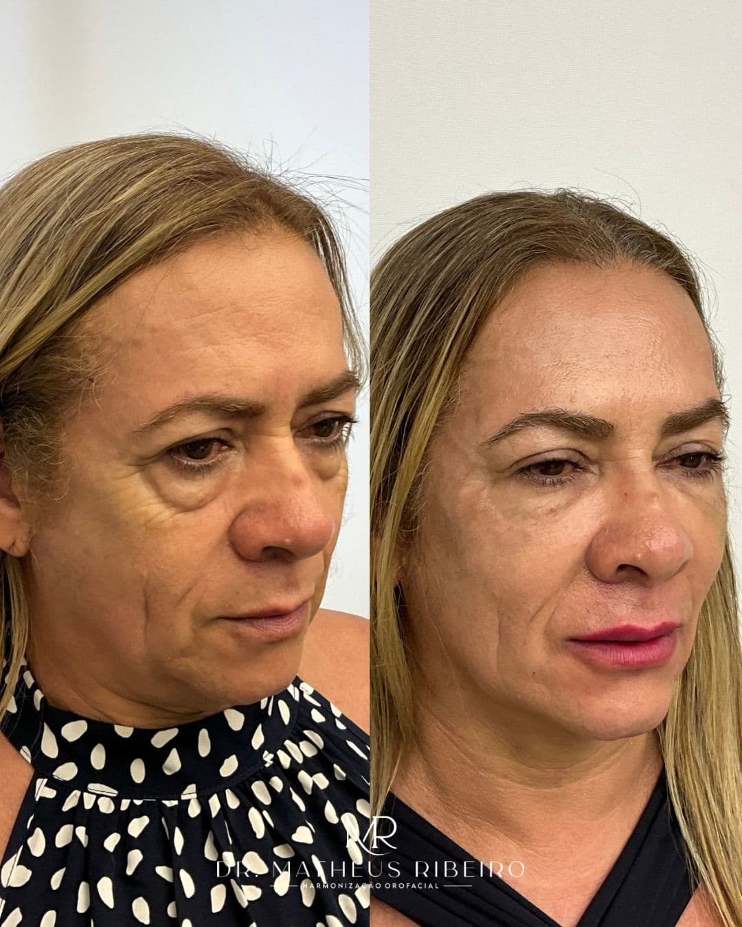 Antes e depois de harmonização facial — mulher na faixa dos 60 anos
