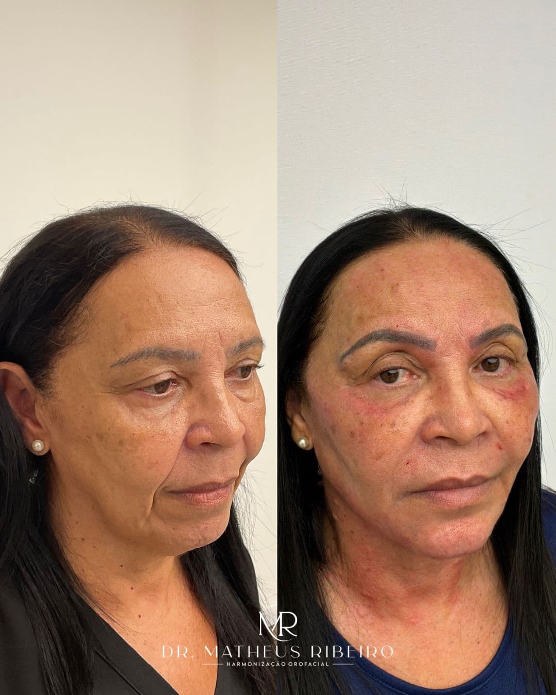 Antes e depois de harmonização facial — mulher na faixa dos 60 anos