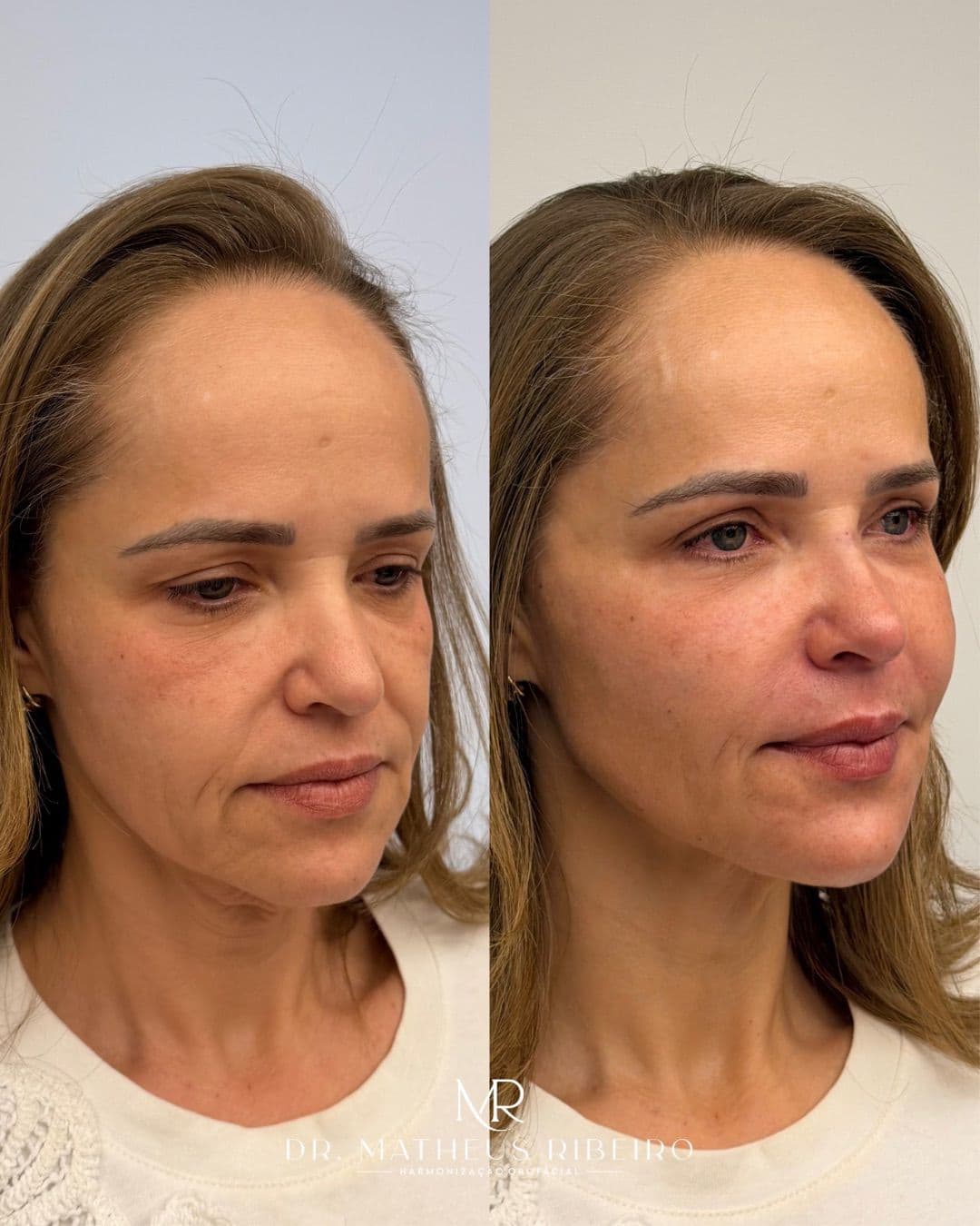 Antes e depois de harmonização facial — mulher na faixa dos 50 anos, perfil em três quartos