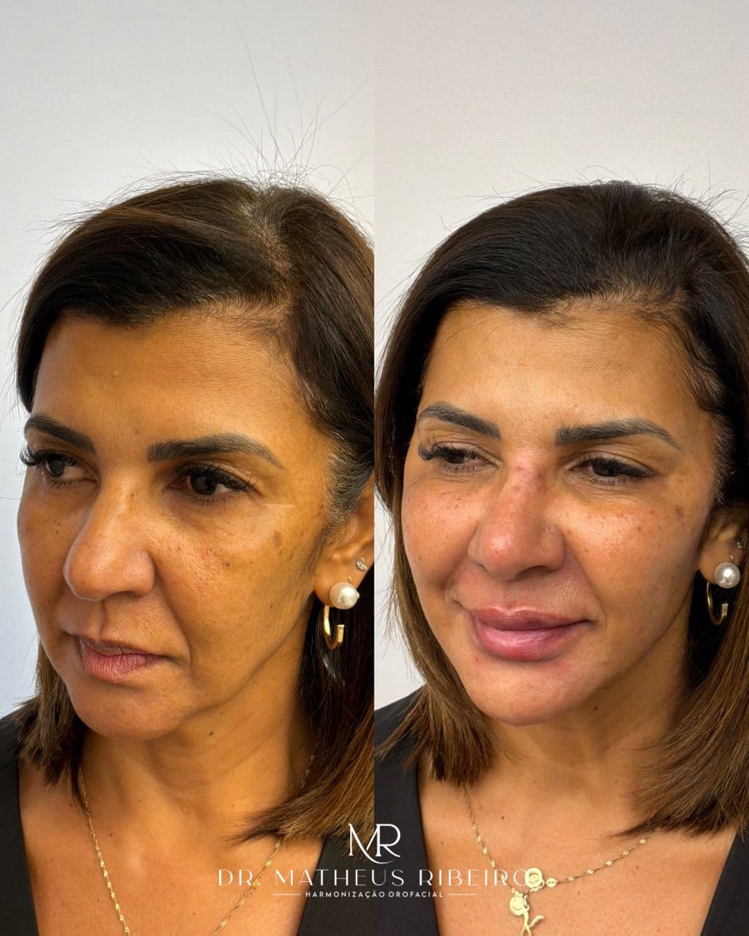 Antes e depois de harmonização facial — mulher na faixa dos 50 anos