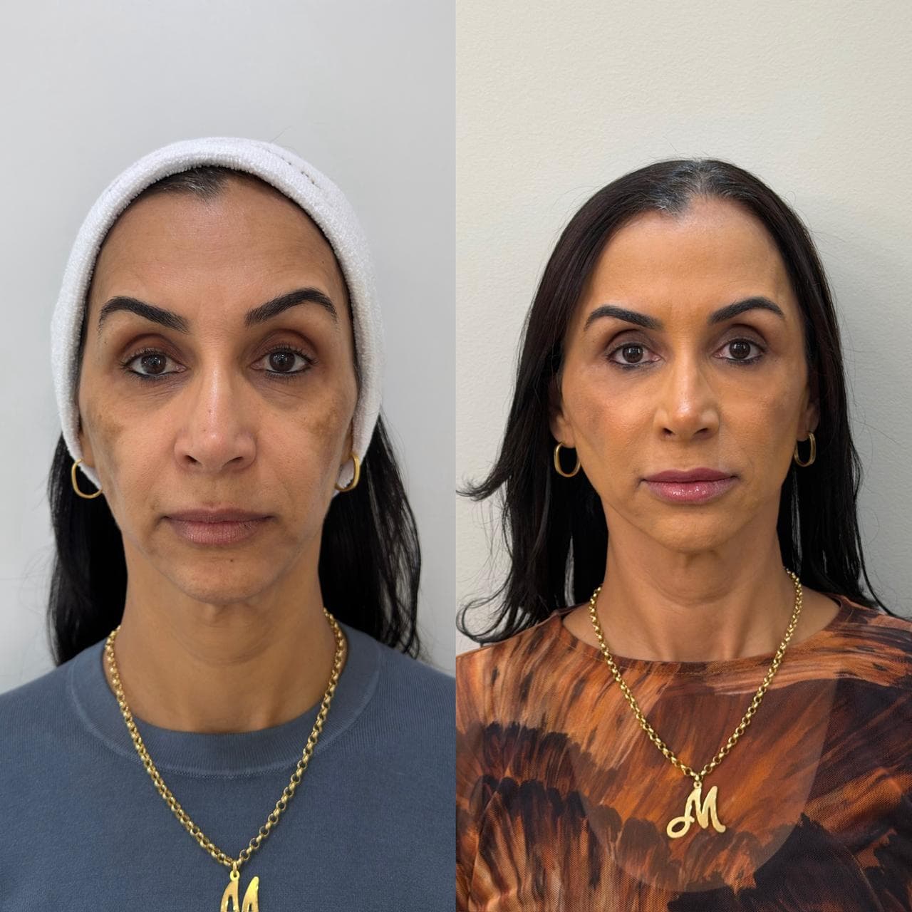 Antes e depois de harmonização facial — mulher na faixa dos 50 anos, vista frontal