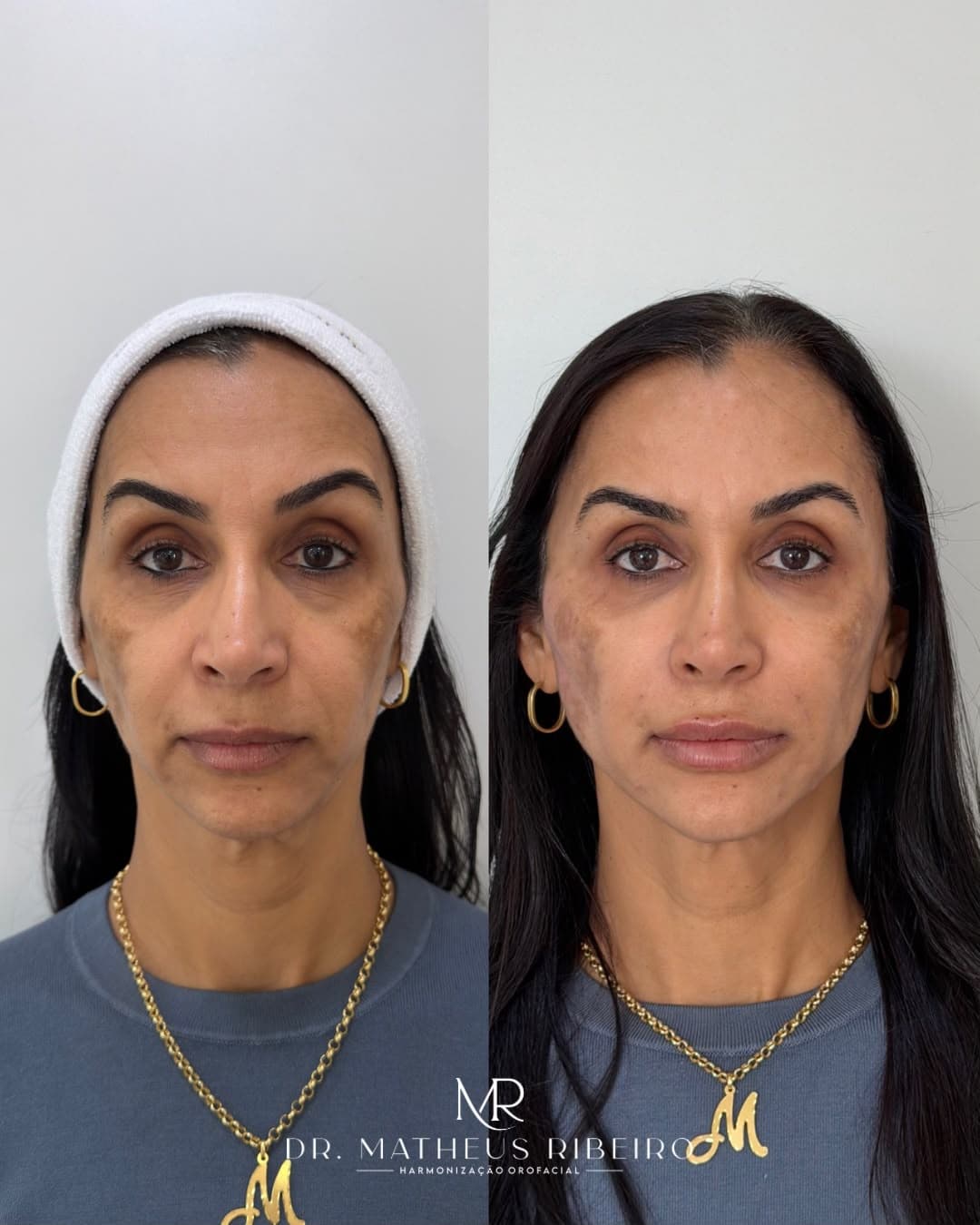 Antes e depois de harmonização facial — mulher na faixa dos 50 anos, vista frontal
