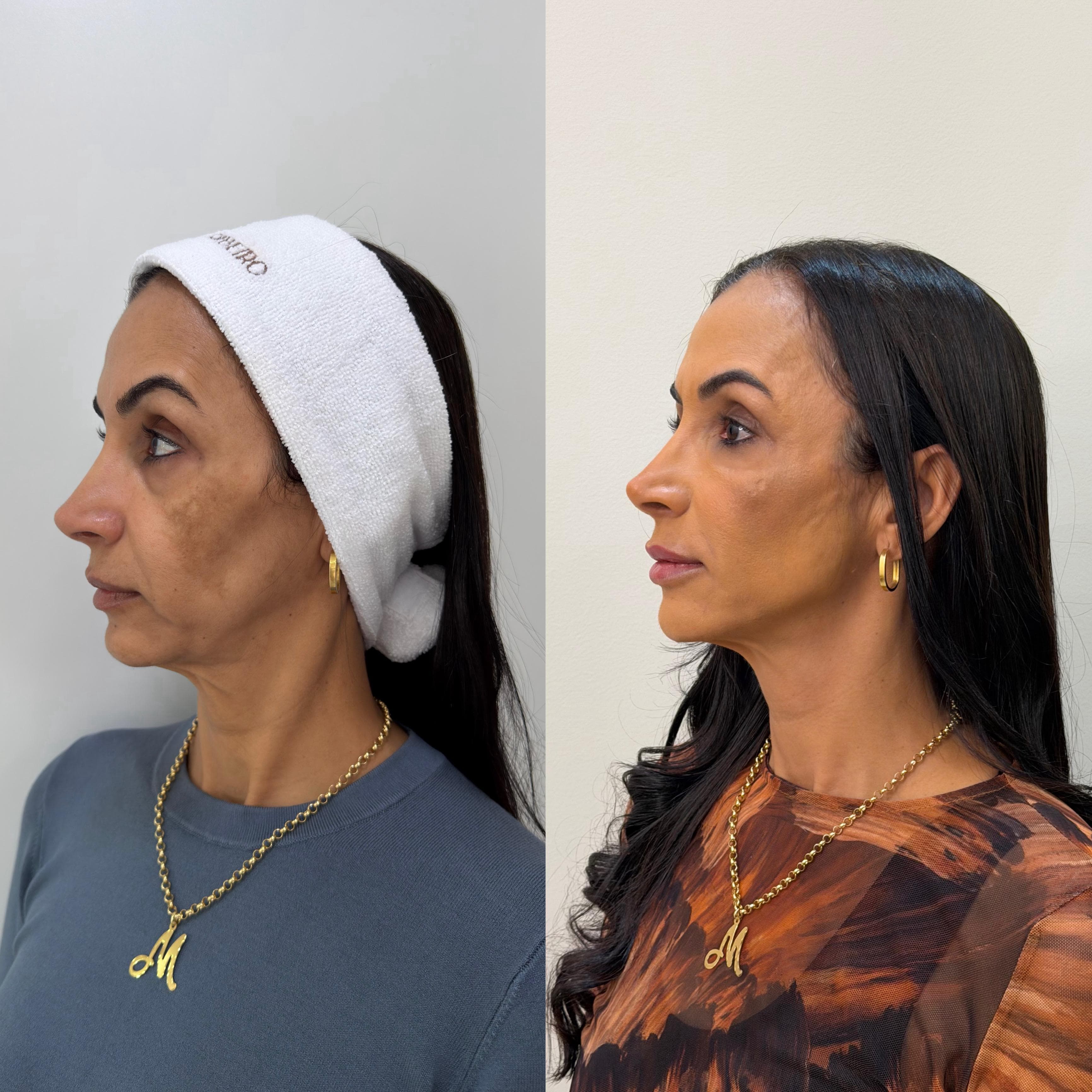Antes e depois de harmonização facial — mulher na faixa dos 50 anos, perfil