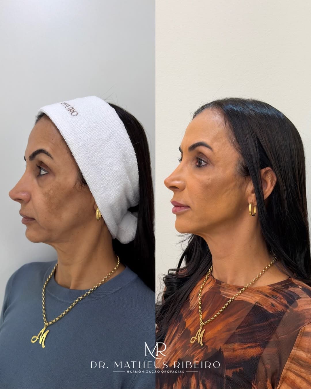 Antes e depois de harmonização facial — mulher na faixa dos 50 anos, perfil